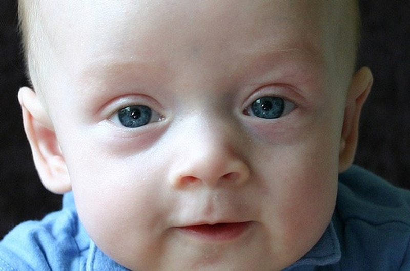 Trẻ sơ sinh bị thâm quầng mắt khiến nhiều phụ huynh lo lắng