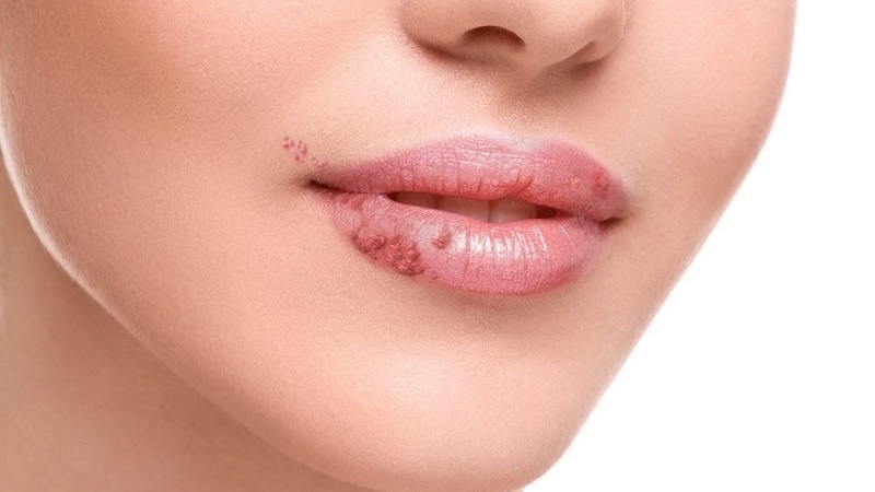 Thận trọng tránh các tác dụng ngoại ý khi phun môi phủ bóng collagen 2