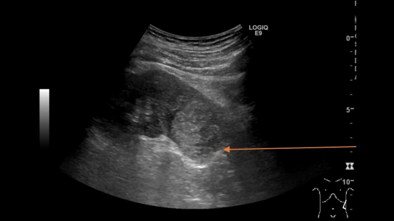 than-u-nuoc-do-3-trieu-chung-va-phuong-phap-dieu-tri 4