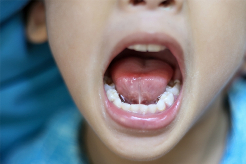 Tật dính thắng lưỡi có nguy hiểm hay không? 2