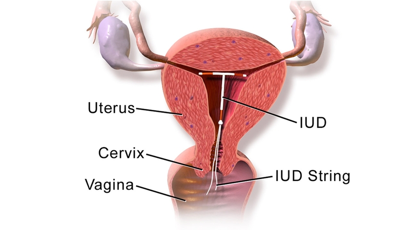 Tháo vòng tránh thai bao lâu thì đặt lại được? 1