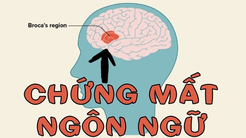 that-ngon-la-gi-nguyen-nhan-dan-den-that-ngon-va-phuong-phap-dieu-tri 1.jpg