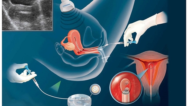 Thắt ống dẫn trứng có thụ tinh nhân tạo được không? 2