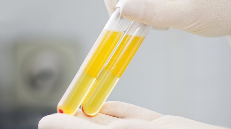 Thay huyết tương: Liệu pháp hiệu quả cho nhiều bệnh lý nguy hiểm 1