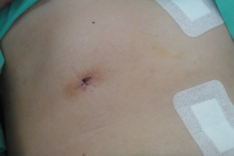 Thay van tim có mổ nội soi được không? Các chỉ định can thiệp thay van tim bạn nên biết 3