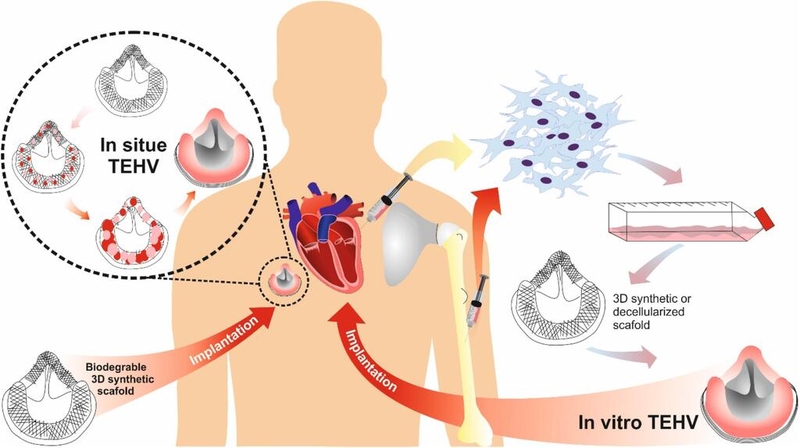 Thay van tim tự thân bằng phương pháp Ozaki được thực hiện như thế nào? 3