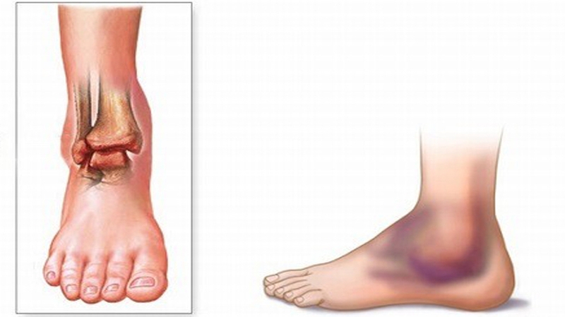 Thế nào là giãn dây chằng cổ chân