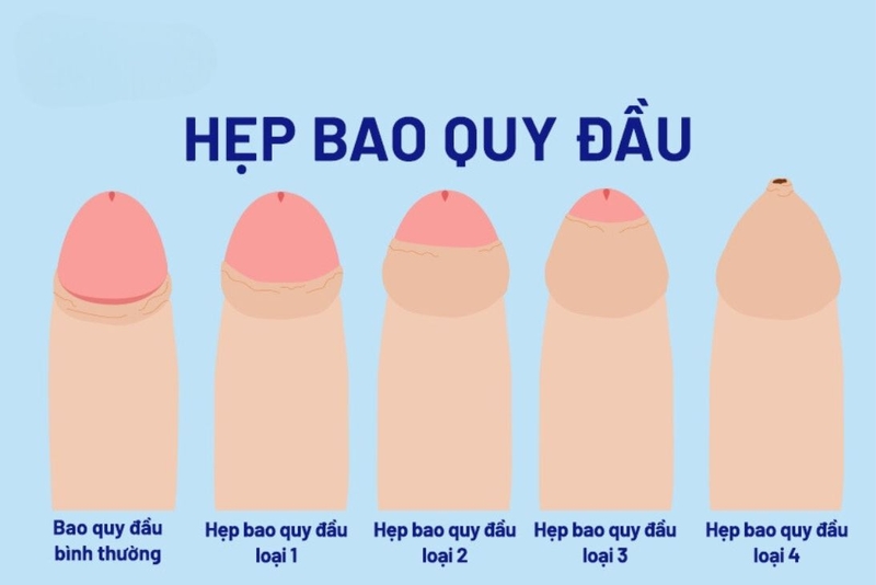 Thế nào là hẹp bao quy đầu? Cần làm gì khi bị hẹp bao quy đầu 1
