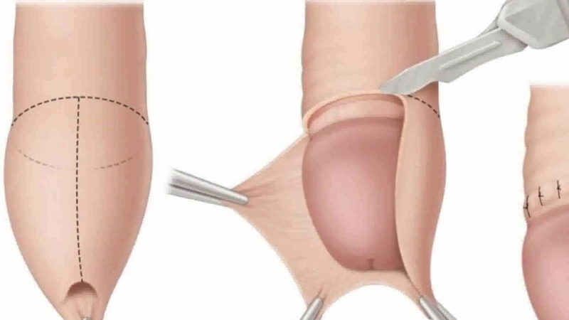 Thế nào là hẹp bao quy đầu? Cần làm gì khi bị hẹp bao quy đầu? 4