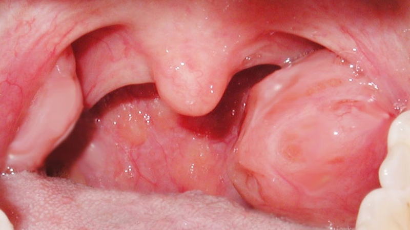 Thế nào là phương pháp cắt amidan bằng laser?