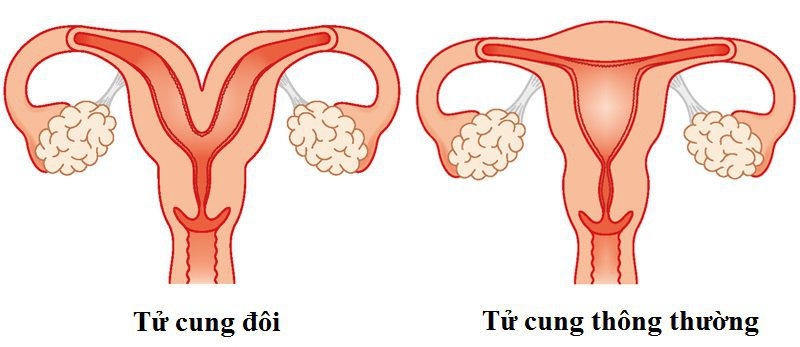Thế nào là tử cung đôi? Phụ nữ bị tử cung đôi liệu có nguy hiểm gì không? 1