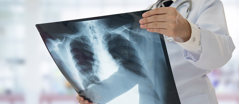 Thế nào là ung thư vòm họng? Ung thư vòm họng cần xét nghiệm gì? 4