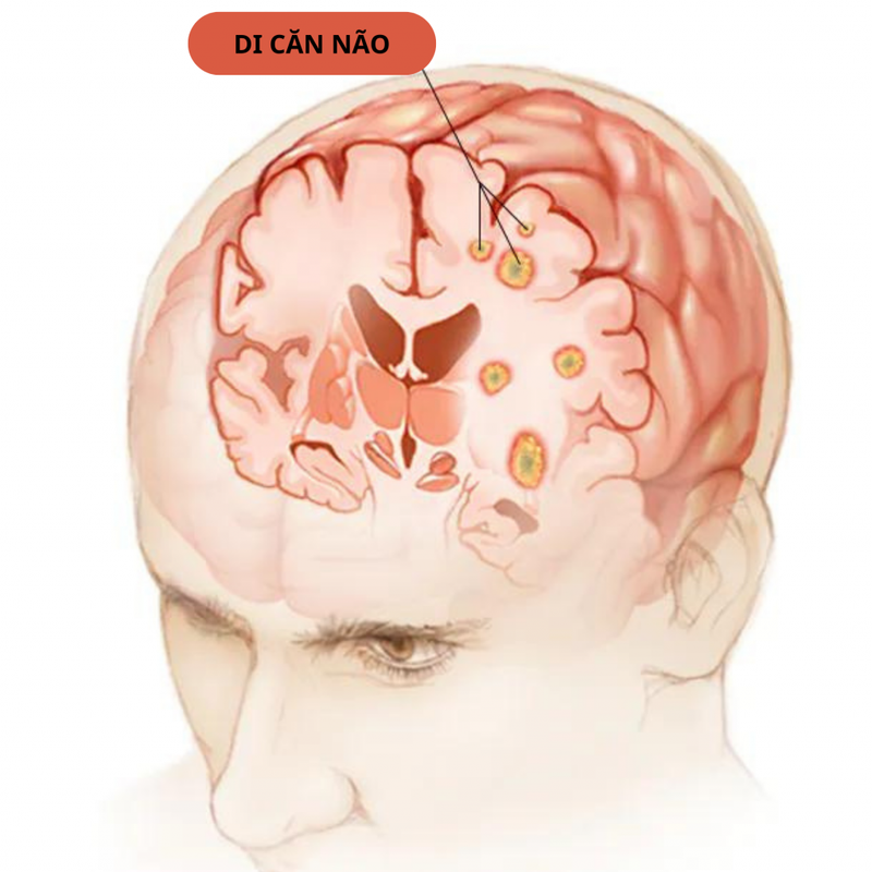 Theo bạn ung thư giai đoạn cuối đau như thế nào? 2