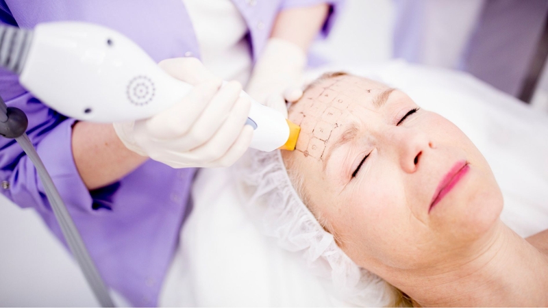 Nhiều yếu tố ảnh hưởng đến thời gian duy trì sau khi làm Thermage FLX