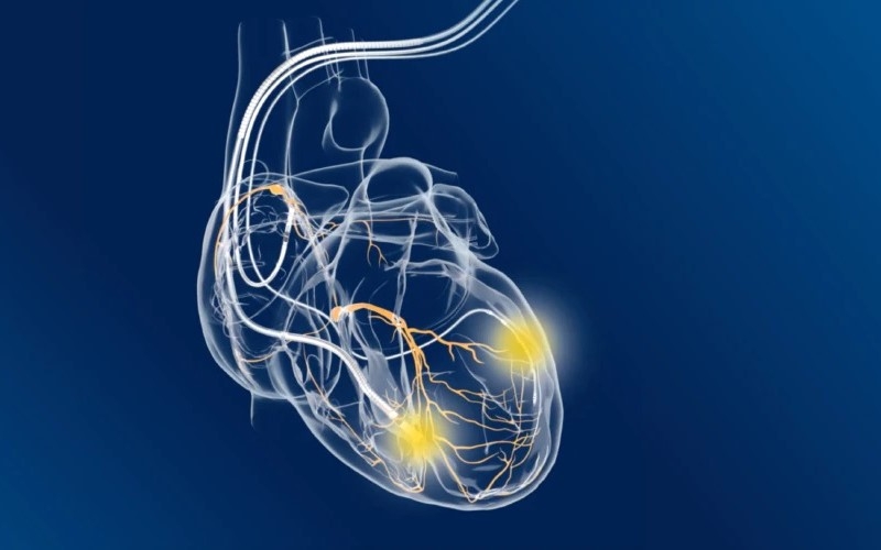 Những trường hợp thường được chỉ định cấy ghép CRT
