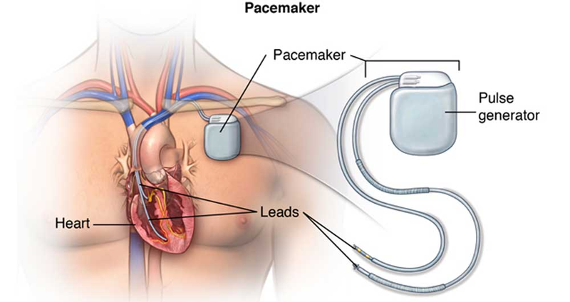 thiết bị tim cấy ghép 2