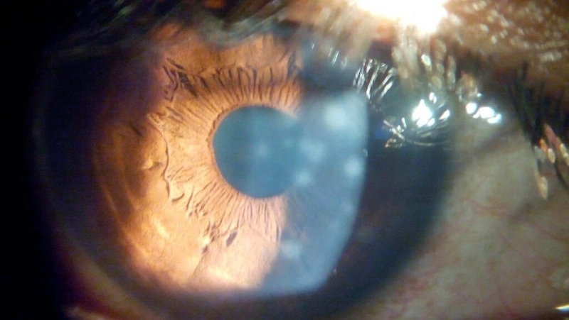 Thiếu HDL gia đình: Nguy cơ tiềm ẩn và những điều bạn cần biết 3