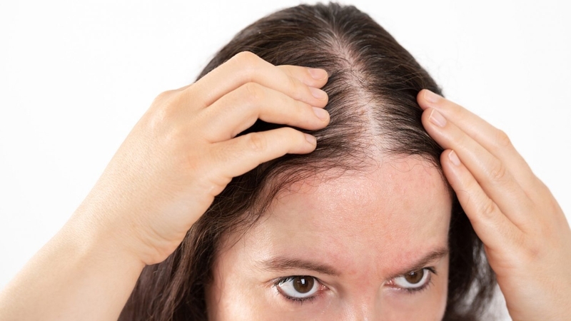 Thiếu canxi gây rụng tóc có phải là vấn đề nghiêm trọng không? 1