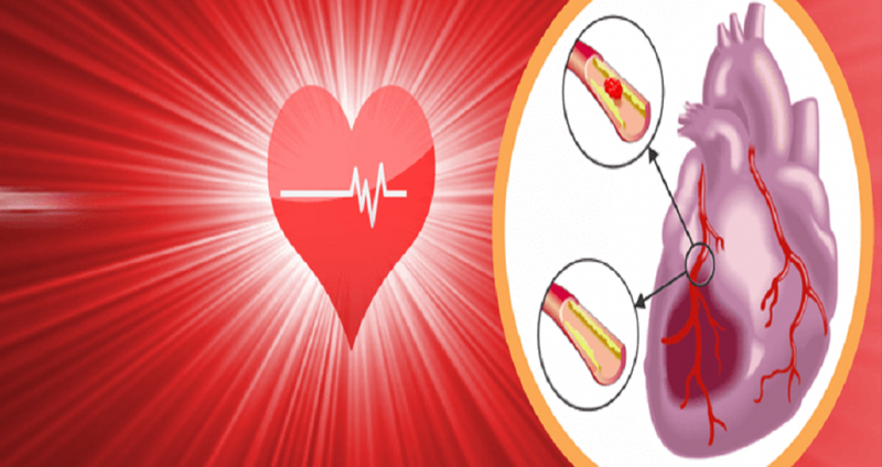 Thiếu máu cơ tim – biến chứng và cách xử lí khi phát bệnh 1