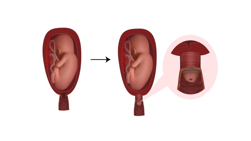 Thiếu máu cổ tử cung là gì? Nguyên nhân và cách điều trị 4
