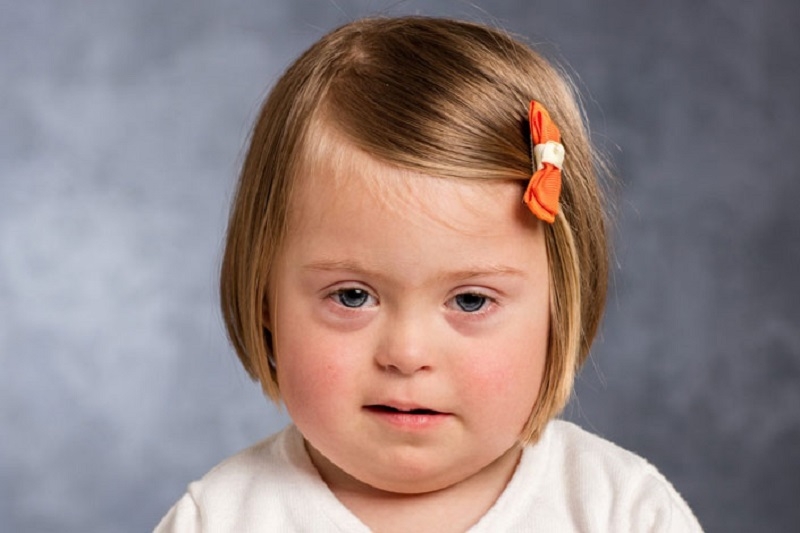 Hội chứng Fragile X gây thiểu năng trí tuệ ở trẻ