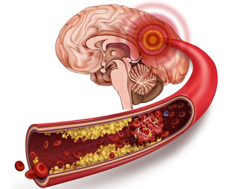 Thiểu năng tuần hoàn não là gì? Cùng tìm hiểu nguyên nhân và cách phòng ngừa hiệu quả 5