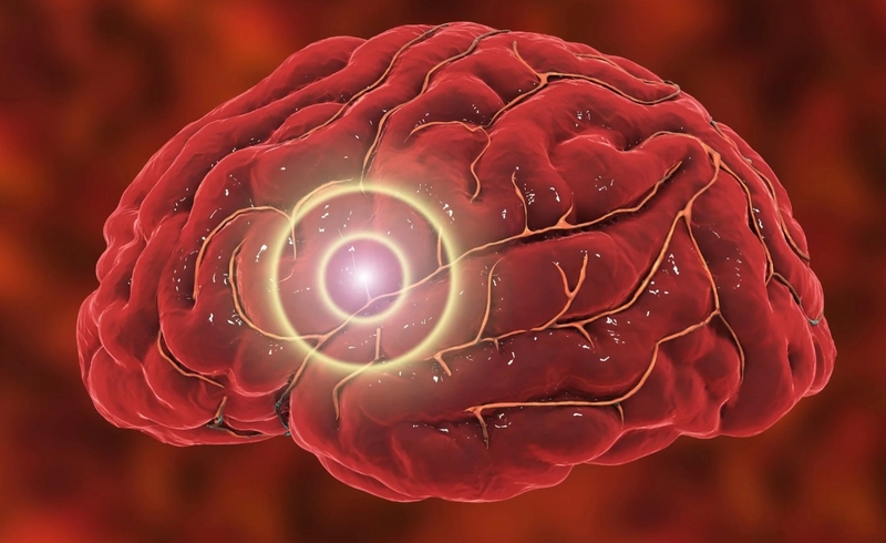 Thiểu năng tuần hoàn não ở người trẻ: Nguyên nhân và cách điều trị 1