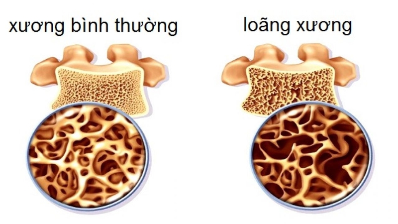 Thiếu phospho gây ra tình trạng loãng xương