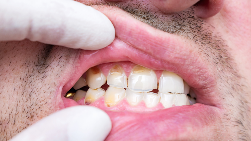 Tổn thương chỉ xảy ra ở một vùng nhất định trên bề mặt răng là biểu hiện của thiểu sản men răng dạng khu trú