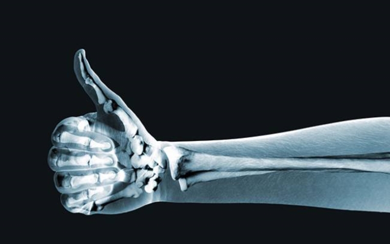 Thiếu vitamin D gây bệnh gì? 3