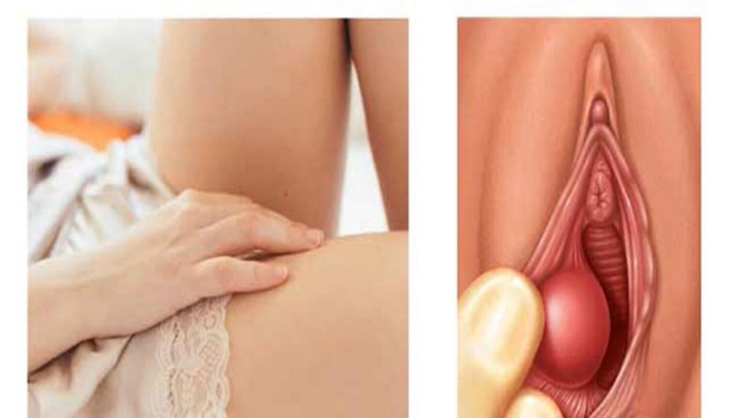 Thịt thừa ở môi bé là bị bệnh gì? Cách điều trị thịt thừa ở môi bé thế nào? 3