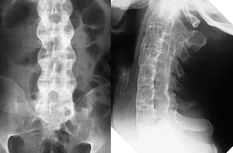 Thoái hóa cột sống: Thoái hóa cột sống dính khớp1