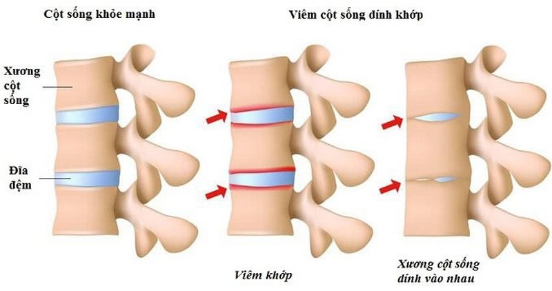 Thoái hóa cột sống: Thoái hóa cột sống dính khớp2
