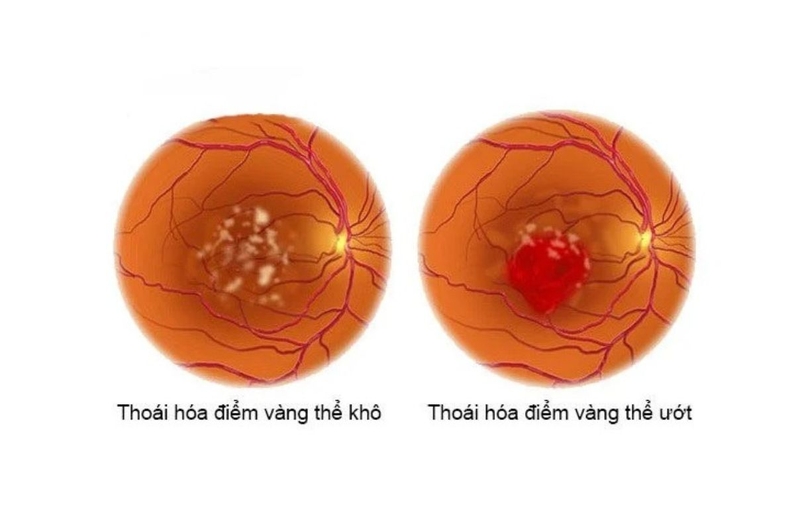 Tìm hiểu chi tiết về bệnh thoái hóa điểm vàng ở thể ướt 1
