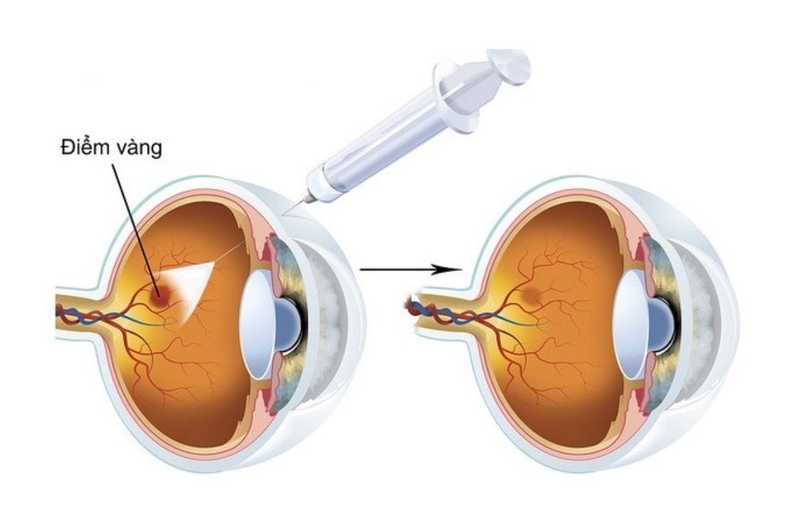 Tìm hiểu chi tiết về bệnh thoái hóa điểm vàng ở thể ướt 3