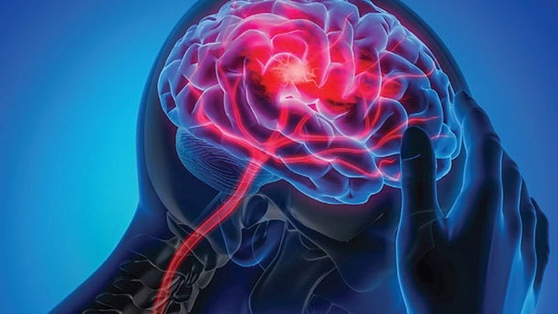 Hậu quả không ngờ của thoái hóa đốt sống cổ gây thiếu máu não1