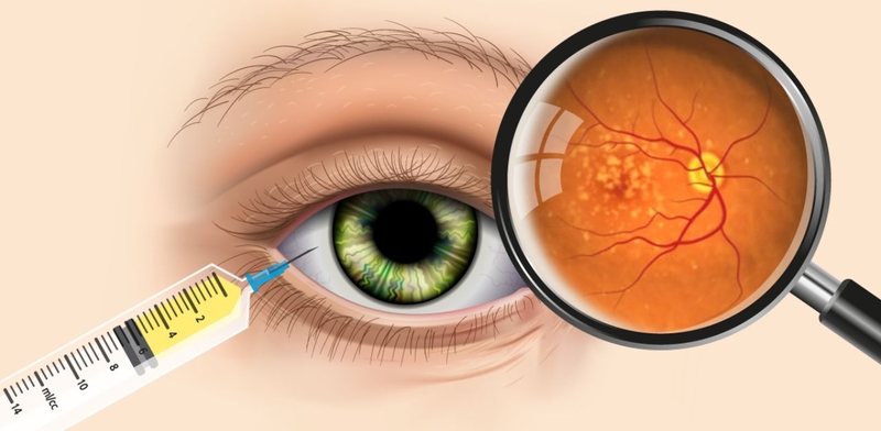 Triệu chứng và cách phòng ngừa thoái hóa hoàng điểm tuổi già 2