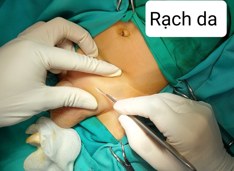 Thoát vị bẹn ở trẻ em và những điều mẹ cần biết 2