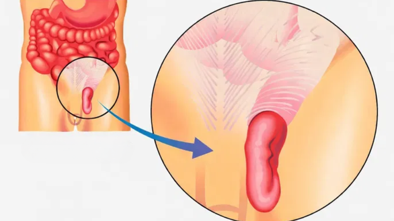 Ở bé trai, ruột có thể chui xuống bìu khiến bìu sưng to bất thường
