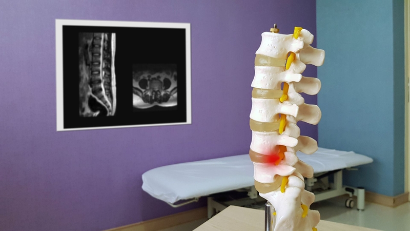 Thoát vị đĩa đệm có bắt buộc phải phẫu thuật không là thắc mắc phổ biến
