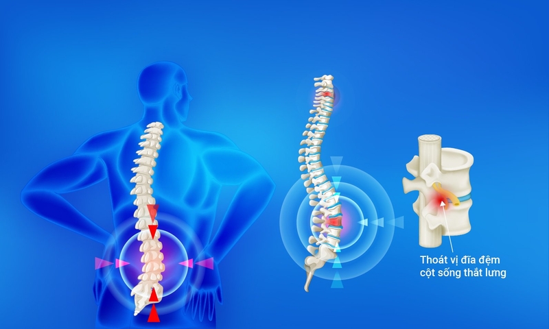 Thoát vị đĩa đệm cột sống thắt lưng có chữa được không? 1