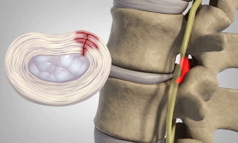 Thoát vị đĩa đệm nội xốp là bệnh gì? Cách phòng tránh và điều trị 1