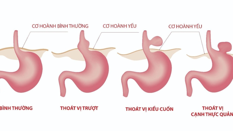 Thoát vị khe hoành là gì? Triệu chứng và cách điều trị