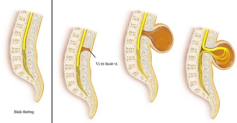 Thoát vị màng não tủy cùng cụt: Chỉ định và quy trình phẫu thuật 2