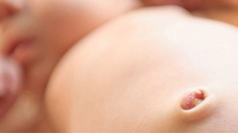 Thoát vị rốn thai nhi là gì? Nguyên nhân và cách điều trị 1