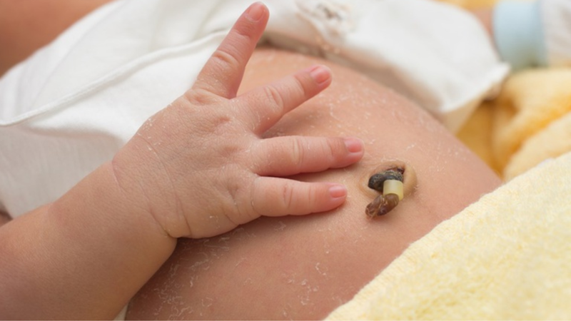 Thoát vị rốn thai nhi là gì? Nguyên nhân và cách điều trị 3