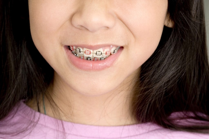 Thời điểm lý tưởng để niềng răng cho trẻ 1
