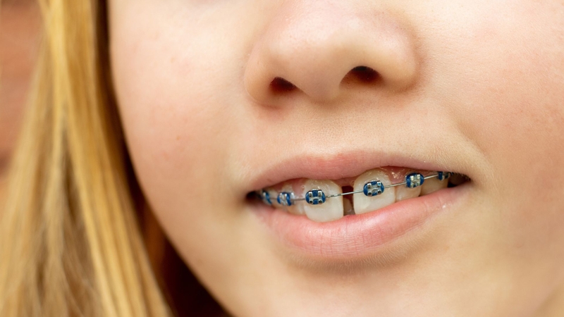 Thời gian hàn răng cửa thưa là bao lâu? Cần lưu ý những gì? 2