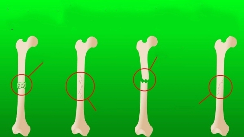 Thời gian liền xương gãy là bao lâu? 3