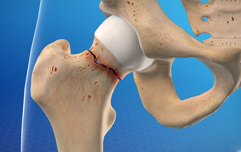 Thời gian liền xương gãy là bao lâu? 4